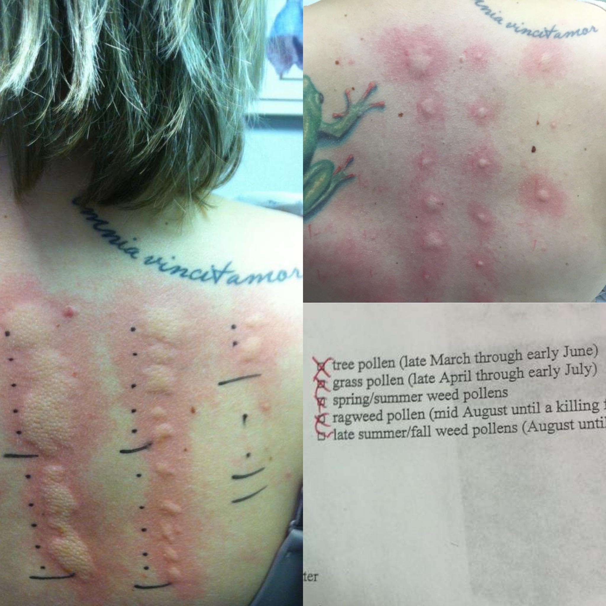 Allergy scratch tests, before (left) and after (top right ...