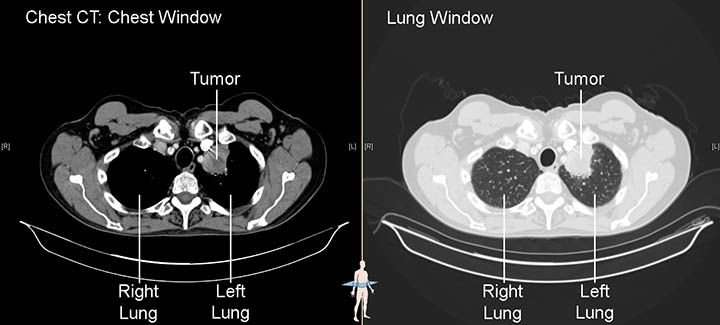 Can Ct Scan Detect Lung Cancer