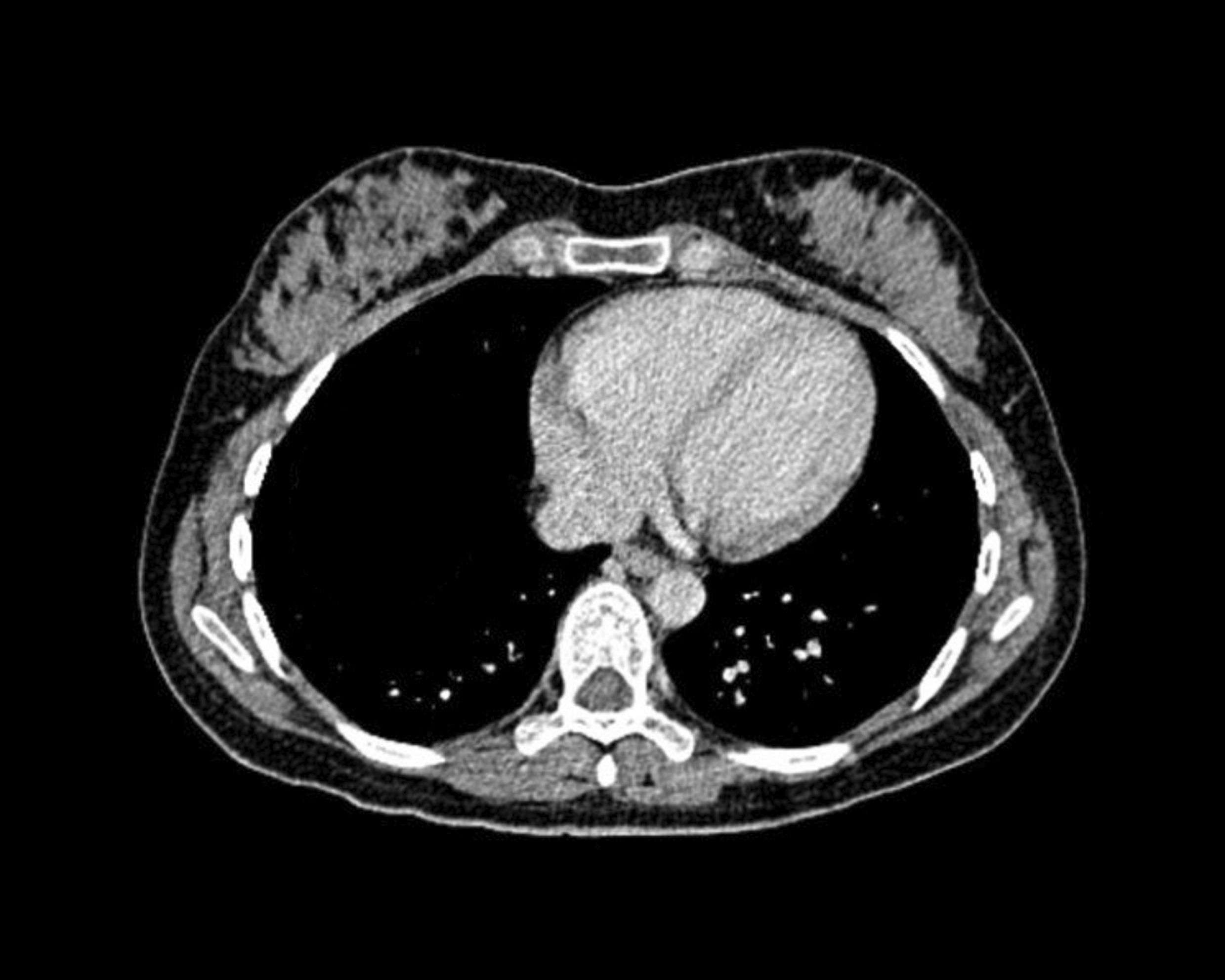 CT Lung Cancer Screening â Issues to Consider