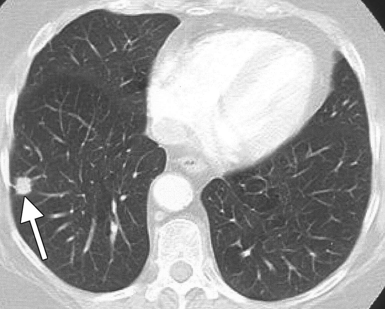 My 2 Cents: Annual Lung CT Scans for Smokers: Good or Bad?
