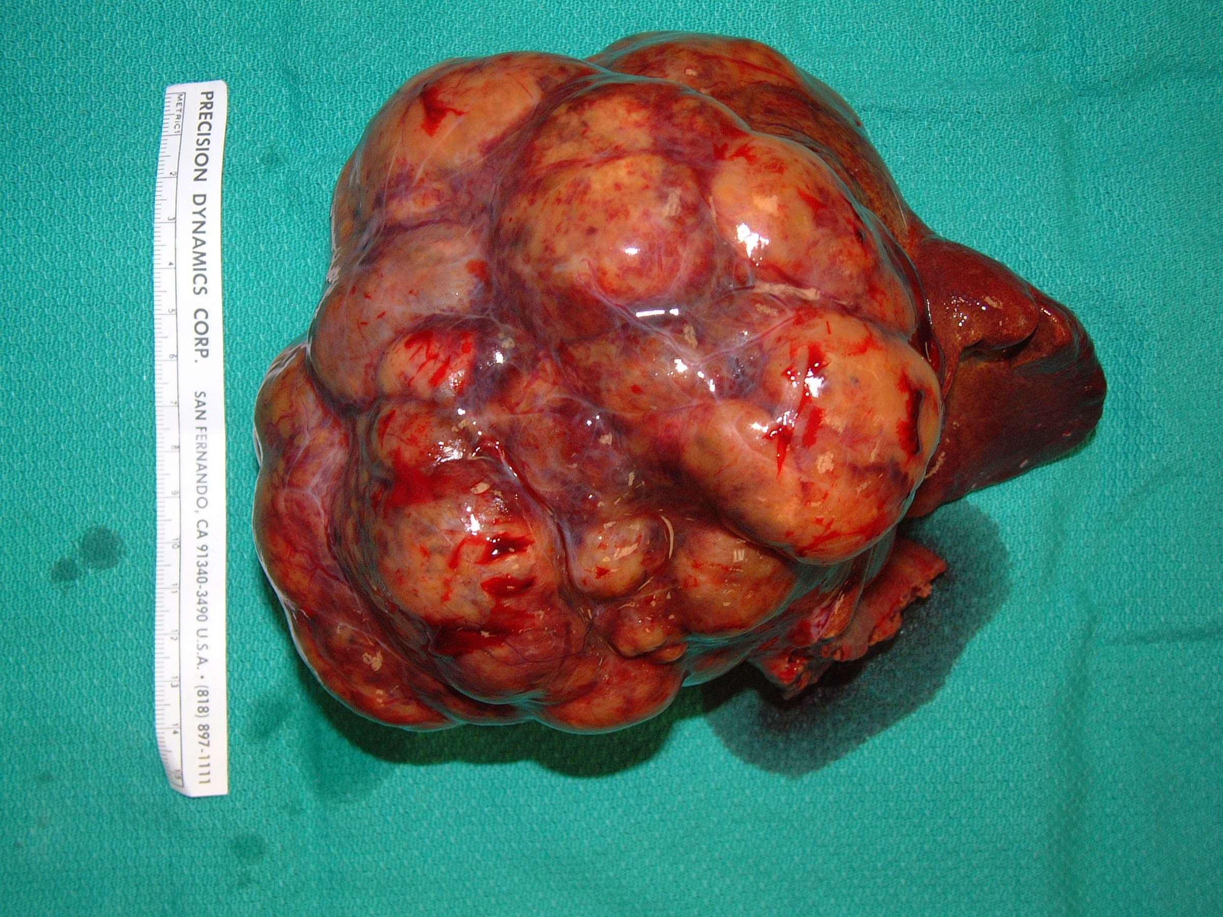 Abdominal Tumors